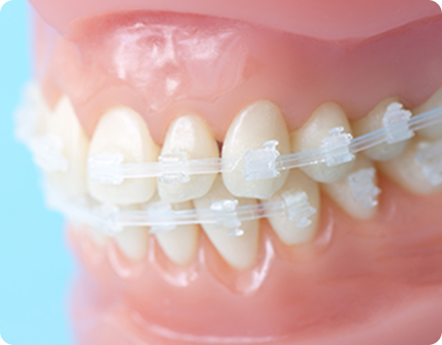 ワイヤーブラケットで矯正している歯
