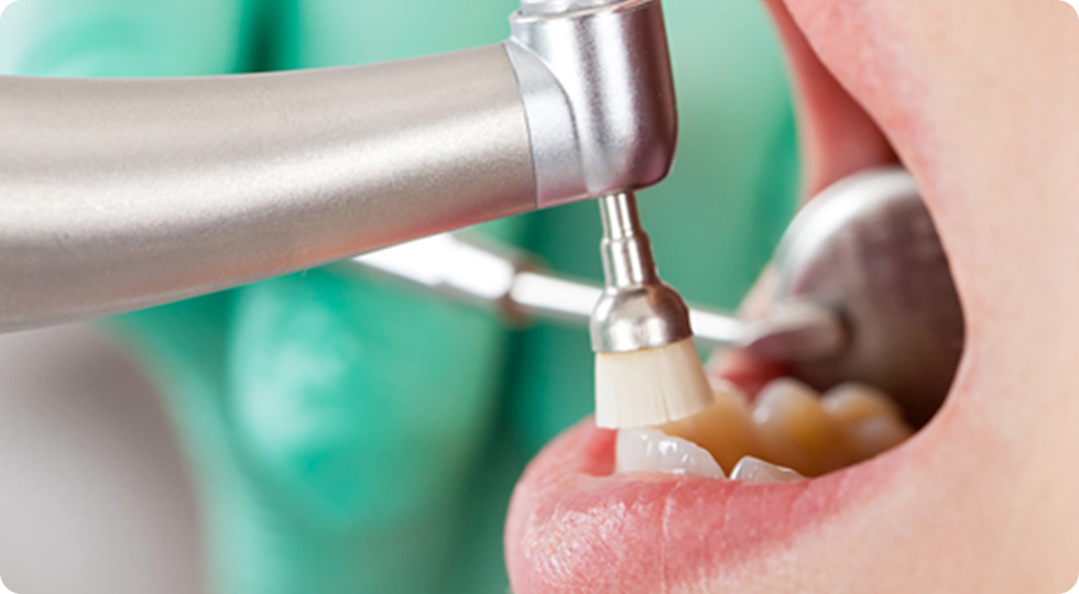 専用の機械で歯垢を取り除いている