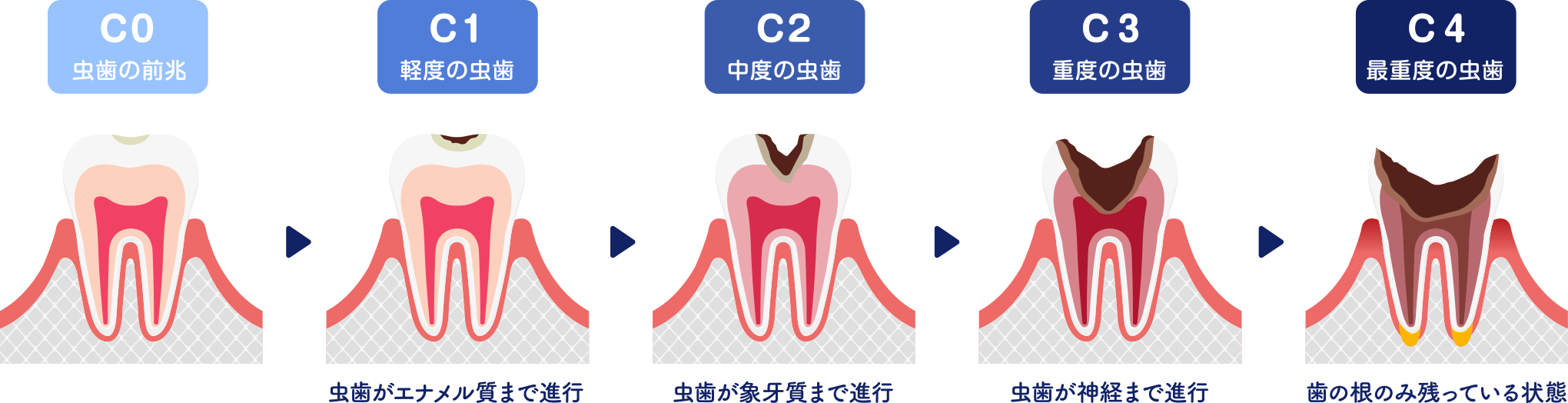 フェーズにあったむし歯治療